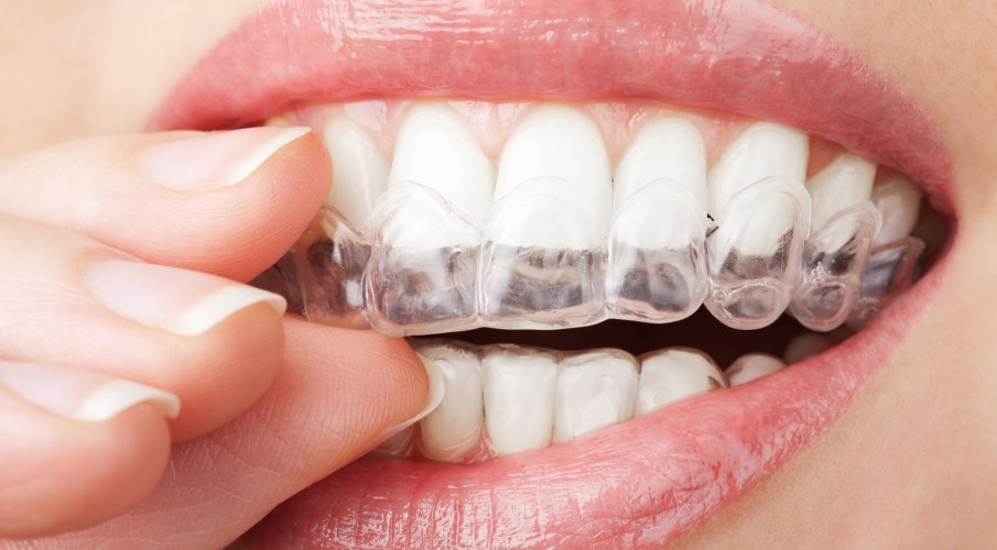 Zahnästhetik mit Zahnarzt Kerzers